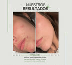DermaXion® Gel Exfoliante Anti-Acné Pro