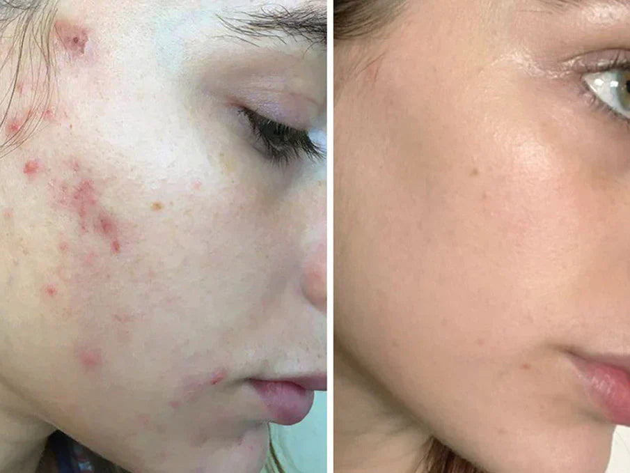 DermaXion® Gel Exfoliante Anti-Acné Pro